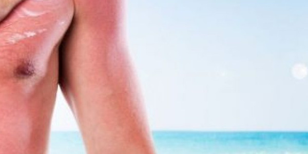 Eritema solare: 8 rimedi da mettere in pratica per alleviare i fastidi