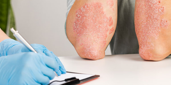 PSORIASI: COS'È, CAUSE E RIMEDI
