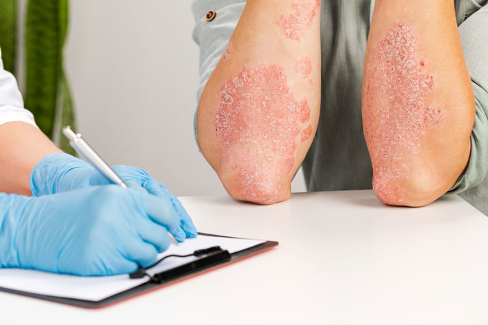 PSORIASI: COS'È, CAUSE E RIMEDI