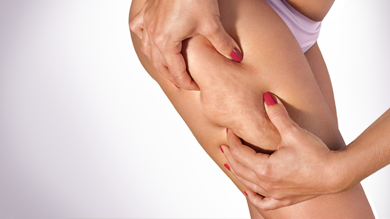ODIO LA CELLULITE!!! MA…CHE COS’E’ LA CELLULITE?